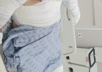 Seu Durval teve 60% do corpo queimado e perdeu tudo após bujão explodir; veja como ajudar 