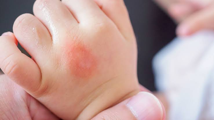 Bebê de apenas 1 mês é a 1ª m*rte por dengue em MS