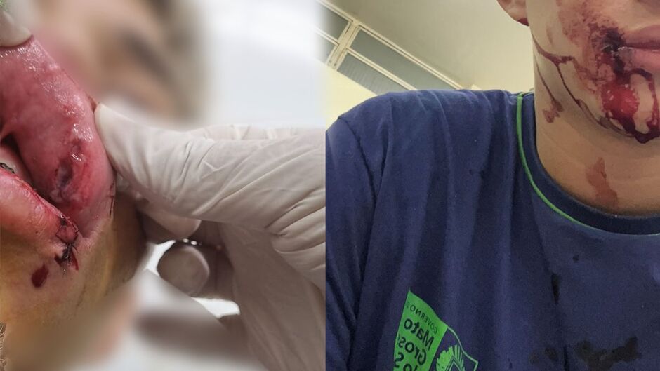 Vídeo: adolescente é agredido com um soco na boca em escola da Capital 