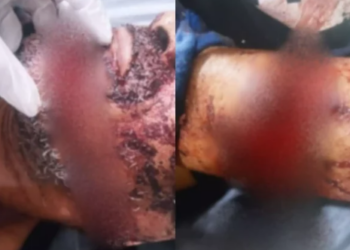 Homem é esfaqueado pela ex e tem mão amputada em Três Lagoas