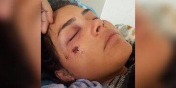 Atingida com tiro no rosto e passando por gravidez de risco, jovem aguarda cirurgia na Santa Casa