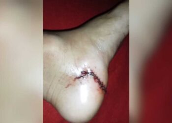 Mãe diz que médica costurou pé do filho com vidro dentro e relata descaso no Coophavila