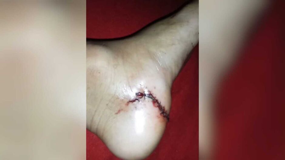 Mãe diz que médica costurou pé do filho com vidro dentro e relata descaso no Coophavila