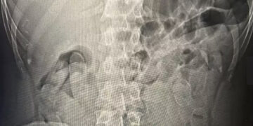 Passageiro de ônibus que engoliu 60 cápsulas de cocaína é preso em Corumbá 