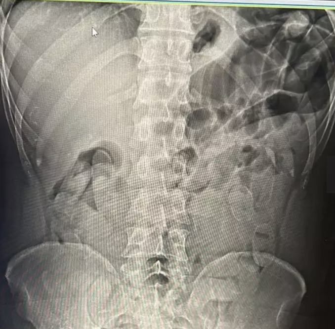 Passageiro de ônibus que engoliu 60 cápsulas de cocaína é preso em Corumbá 