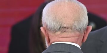 Lula conversa, se alimenta normalmente e não terá sequelas, dizem médicos