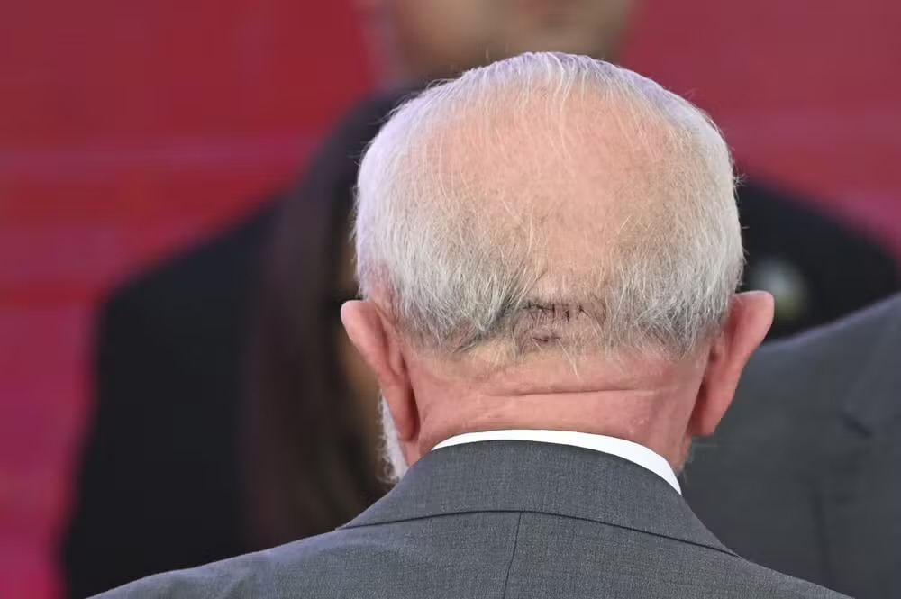 Lula conversa, se alimenta normalmente e não terá sequelas, dizem médicos