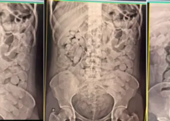 Operação Ágata: Mulheres são flagradas com cocaína no estômago em Corumbá