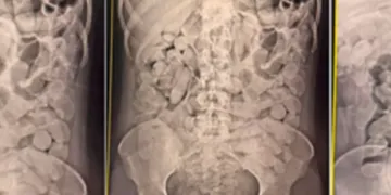 Operação Ágata: Mulheres são flagradas com cocaína no estômago em Corumbá