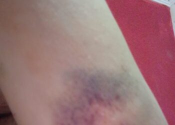 Vítima de agressão em Ribas do Rio Pardo faz manifestação para evidenciar casos de violêmcia contra mulher