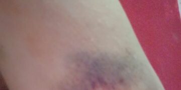 Vítima de agressão em Ribas do Rio Pardo faz manifestação para evidenciar casos de violêmcia contra mulher