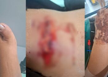 Motociclista ferida em acidente na Guaicurus está com quadro delicado e aguarda cirurgia na Santa Casa