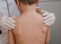 Alerta de meningite mobiliza autoridades e comunidade em Campo Grande Alerta de meningite mobiliza autoridades e comunidade em Campo Grande