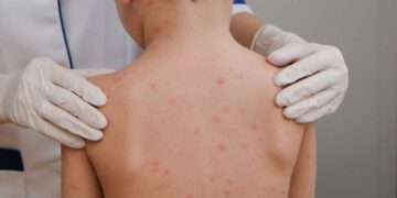 Alerta de meningite mobiliza autoridades e comunidade em Campo Grande