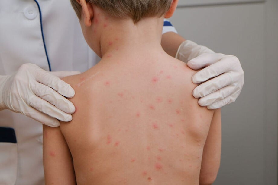 Alerta de meningite mobiliza autoridades e comunidade em Campo Grande