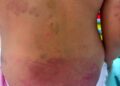Menina autista de 6 anos é agredida no Paraguai e padrasto acaba preso Menina autista de 6 anos é agredida no Paraguai e padrasto acaba preso