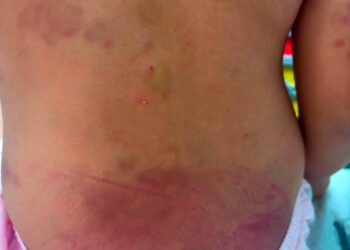 Menina autista de 6 anos é agredida no Paraguai e padrasto acaba preso Menina autista de 6 anos é agredida no Paraguai e padrasto acaba preso