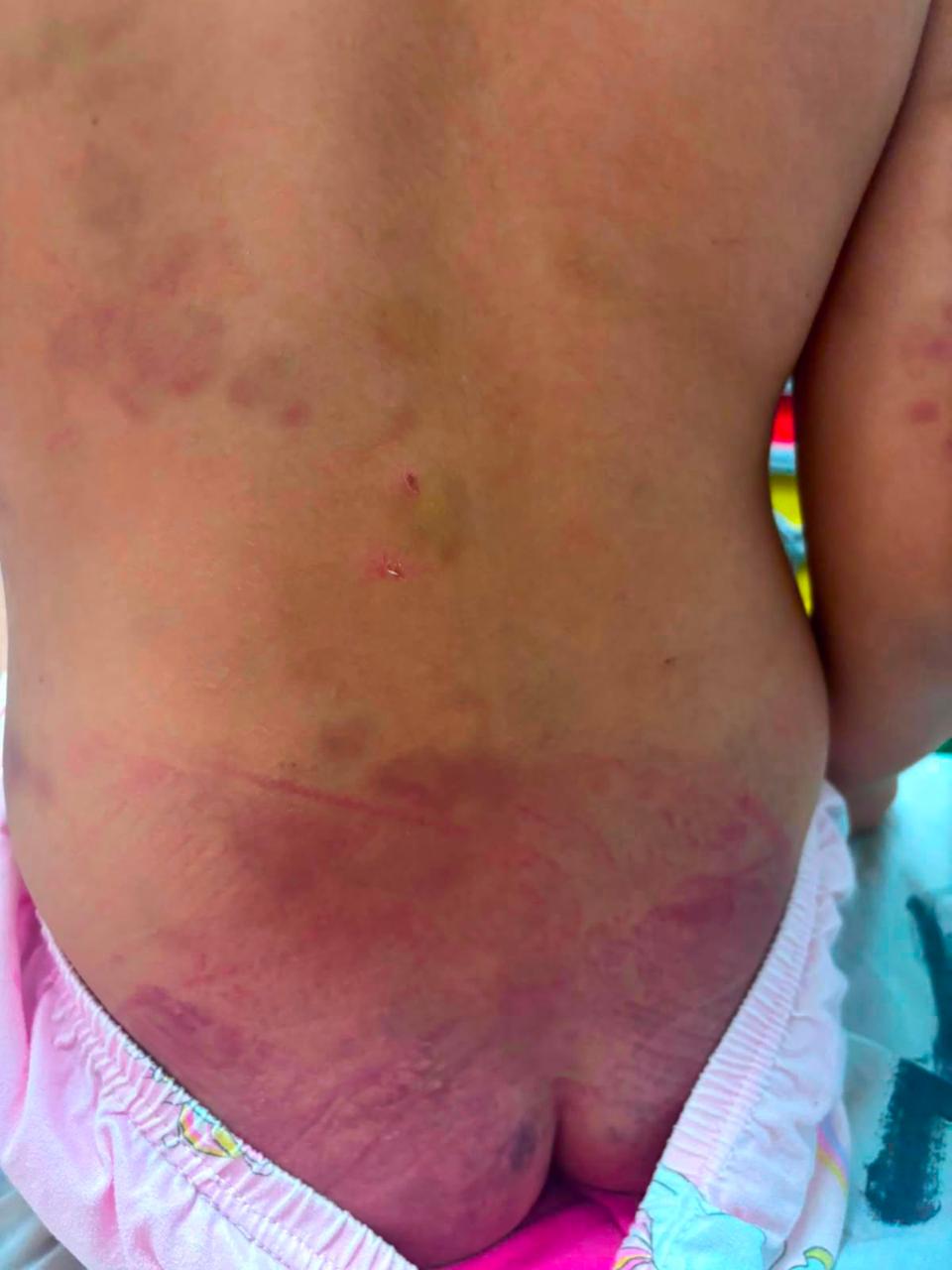 Menina autista de 6 anos é agredida no Paraguai e padrasto acaba preso